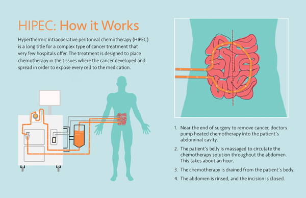 how hipec works infographic