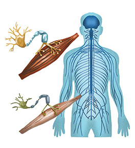 Graphic showing the human nervous system with closeups of dead and healthy nerve cells.