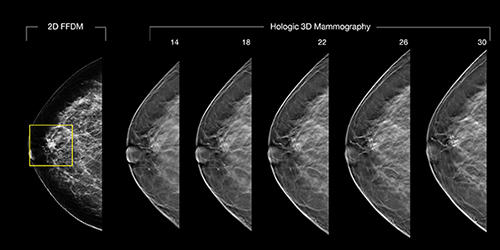 A potential malignancy in a patient's 2-D mammogram, left, turns out to be nothing suspicious in 3-D imaging of the same breast.
