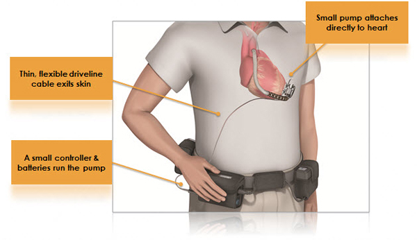 lvad illustration