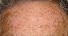 UCI Health vitiligo patient before excimer laser treatment