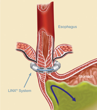 LINX device fitted around the lower esophageal sphincter