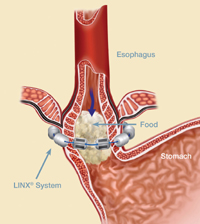LINX device expands as needed around the lower esophageal sphincter