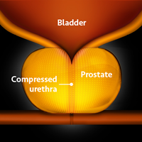 An enlarged prostate compresses the urethra, which causes annoying urinary tract symptoms in older men