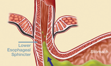 Gastroesophageal reflux disease occurs when a weakening of the lower esophageal sphincter allows stomach acids to wash back into the esophagus.