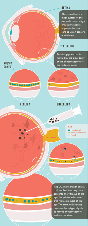 stem cell clinical trial for retinitis pigmentosa