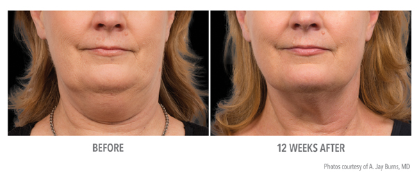 Before and after photo of a patient's chin after CoolSculpting