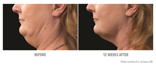 Before and after photo of patient's chin after CoolSculpting