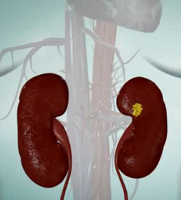 Two kidneys with a kidney stone in the right kidney