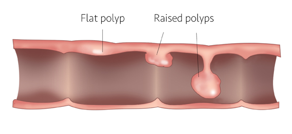 flat polyp side 600