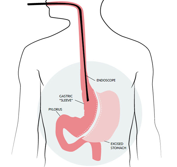 sleeve gastroplasty illustration