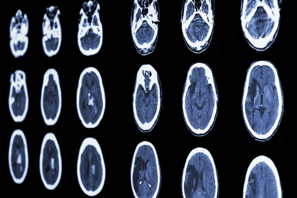 images of brain after stroke