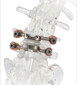 Spine device may offer alternative to spinal fusion