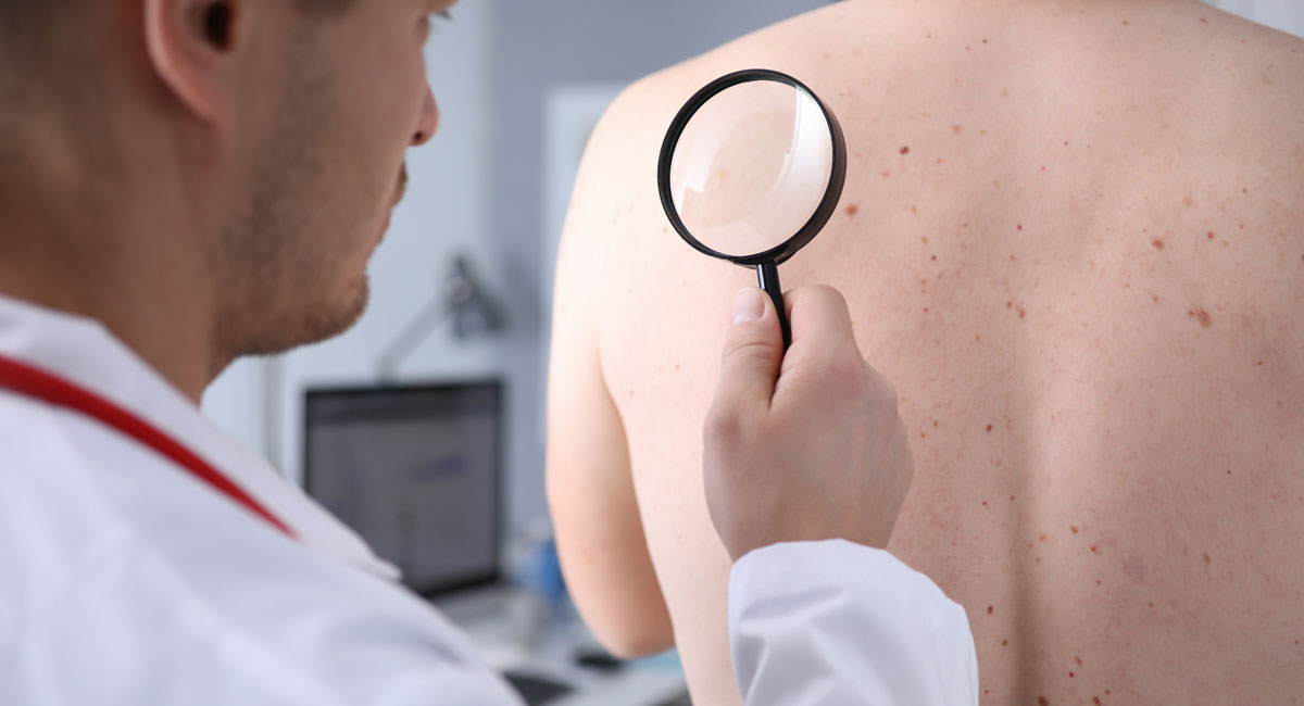 Transplant patients at risk for skin cancer UCI Health Orange