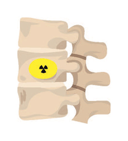 blog size_264x291_radioactive bone cement 2