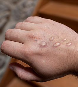 A man's hand showing monkeypox lesions.