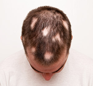 Alopecia areata can cause hair to fall out in patches on the scalp, as with this young man.