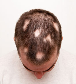 Alopecia areata can cause hair loss like the patches on this man's head.