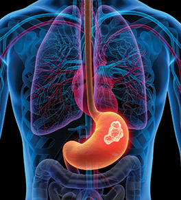 Illustration of stomach with cancer tumors
