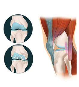 Illustration of muscles that can help support the knee when cartilage in the joint breaks down from osteoarthritis.