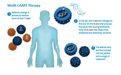 An illustration shows the three steps involved in the novel MuSK-CAART therapy for a rare form of myasthenia gravis being studied in a phase 1 clinical trial at the UCI Alpha Clinic.