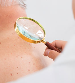 caucasian man with moles on his back being examined by a physician with a magnifying glass