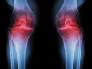 Knee arthritis appears as red inflammation on imaging scan.