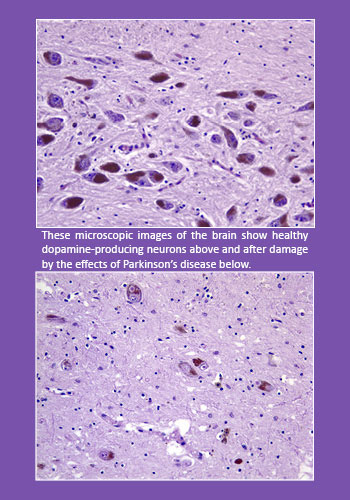Graphic showing photos of the brain's dopamine-producing neurons under a microscope before and after Parkinson's disease effects.