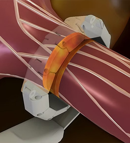 This illustration shows the HyperQure™ laparorscopic device wrapped around a kidney artery and applying heat to destroy the renal nerves. Increased activity of the renal nerves, pictured as white lines on the artery's outer wall, is linked to uncontrolled hypertension.