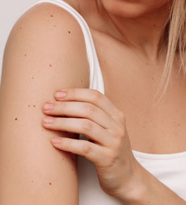 young caucasian woman touching her arm which is covered in moles