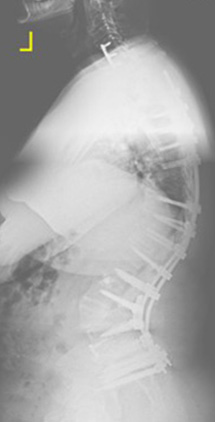 Dominick Maggio's post-surgery X-ray showing his realigned spine.