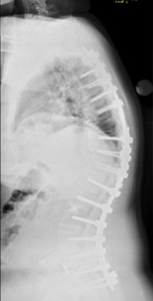 A sideview X-ray of Dominick Maggio's spine before surgery showing he is hunched over and other deformities.