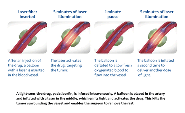 The illustration above shows how a tiny catheter equipped with a laser illumination device is used in two 5-minute increments to activate a drug that can destroy pancreatic tumors.