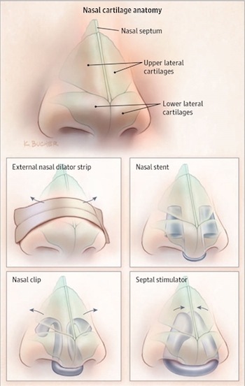 Illustration of nasal dilators