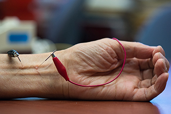 UC Irvine researchers at the Susan Samueli Center for Integrative Medicine find that acupuncture lowers hypertension by activating natural opioids.