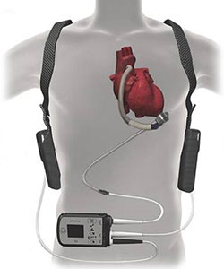 LVAD heart device