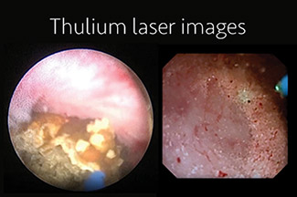 Super-pulsed thulium laser used on kidney stones.