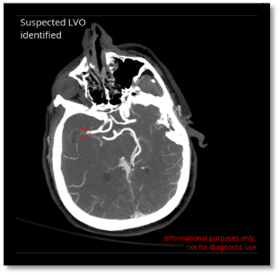 Image of large vessel occlusions (LVO)