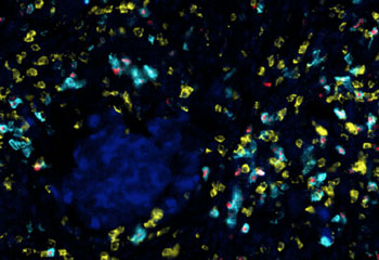 research showed that CD8+ T cells (yellow) activated by PD-1 blockade also interact with T regulatory cells (teal and red), which subsequently dampen the immune response against the melanoma tumor cells (blue). UC Irvine School of Medicine, Department of Physiology & Biophysics and Institute for Immunology