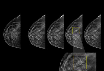 an image of the breast showing a suspicious area on a mammogram black and white