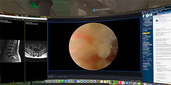 AR-assisted endoscopic spinal fusion allows the doctor to see patient medical record and x-rays in the same field of vision.