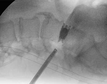 Endoscopic image of surgical near the patient's vertebrae.