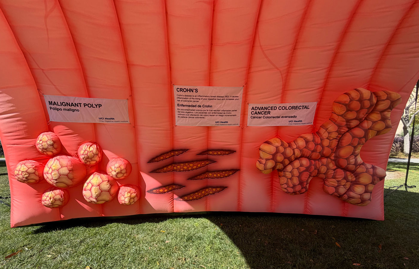 an inflatable megacolon showing malignant cancer polyps and crohns disease