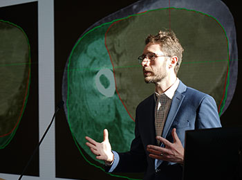 UCI Health radiation oncologist Dr. Jeremy Harris explains his Anti-Cancer Challenge research project to improve radiation therapy at a podium with an image of a large cancer tumor projected on a screen behind him.