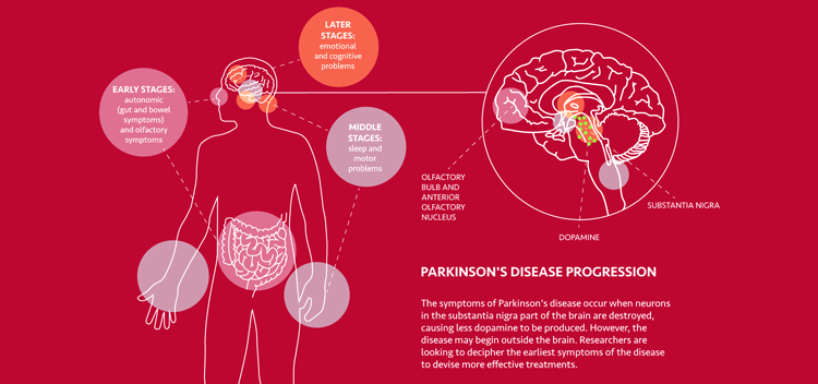 Parkinson's disease progression