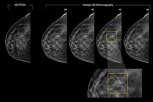 3-D mammography detects cancer in patient where 2-D image, left, does not.
