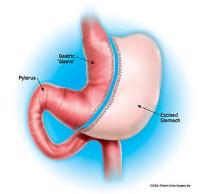 Vertical Sleeve Gastrectomy