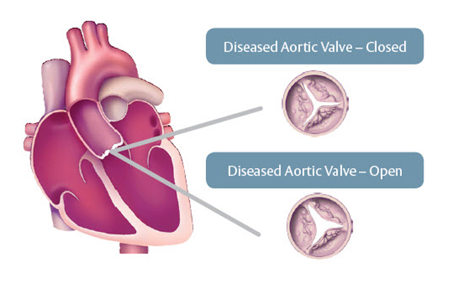 diseased heart valve with aortic stenosis
