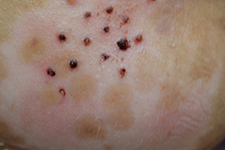 UCI Health vitiligo patient before skin graft therapy