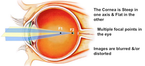 Astigmatism